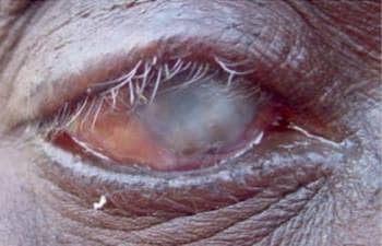 El tracoma es una enfermedad ocular que resulta de la infección por Chlamydia trachomatis, una bacteria.
Constituye un problema de salud pública en 37 países y es la causa de la ceguera o la incapacidad visual de 1,9 millones de personas.
La ceguera causada por el tracoma es irreversible.